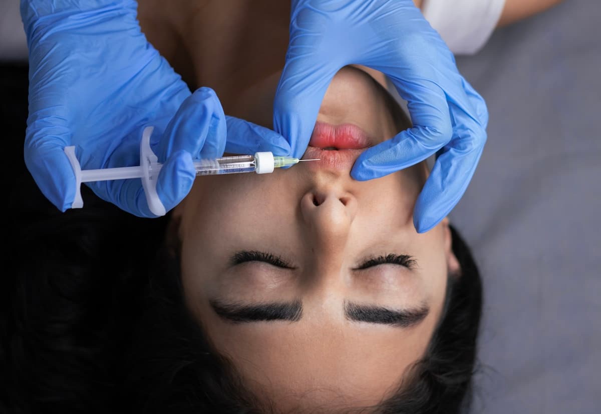 Lip augmentation procedure